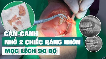 Trực Tiếp Nhổ 2 Chiếc Răng Khôn Mọc Lệch 90 Độ Gây Đau Nhức.