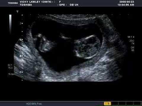 john and vickys lawley baby scan video at 13 weeks...