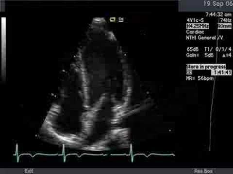 online transcatheter closure of asds