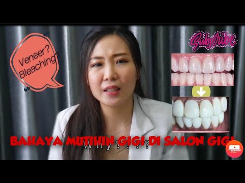 Video: Veneer Gigi - Jenis, Petunjuk Penggunaan, Kelebihan Dan Kekurangan, Ulasan, Sebelum Dan Sesudahnya