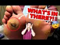 Guess whats hiding under this ulcer surprise inside   ulcer and callus removal  dr kim