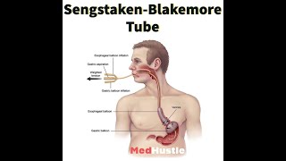 Sengstaken Blakemore Tube Minnesota Tube