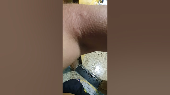 O DIA QUE A VESPA ME PICOU