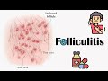 Folliculitis - Causes, Signs &amp; Symptoms, Complications &amp; Treatment