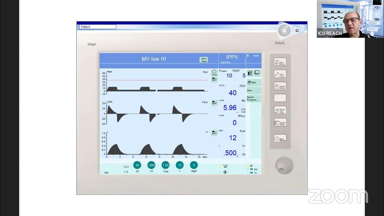 Pressure Regulated Volume Control (PRVC) YouTube