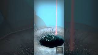 How LASIK Surgery Works | 3D Medical Animation #shorts #3danimation #lasik #medicalanimation #eyes
