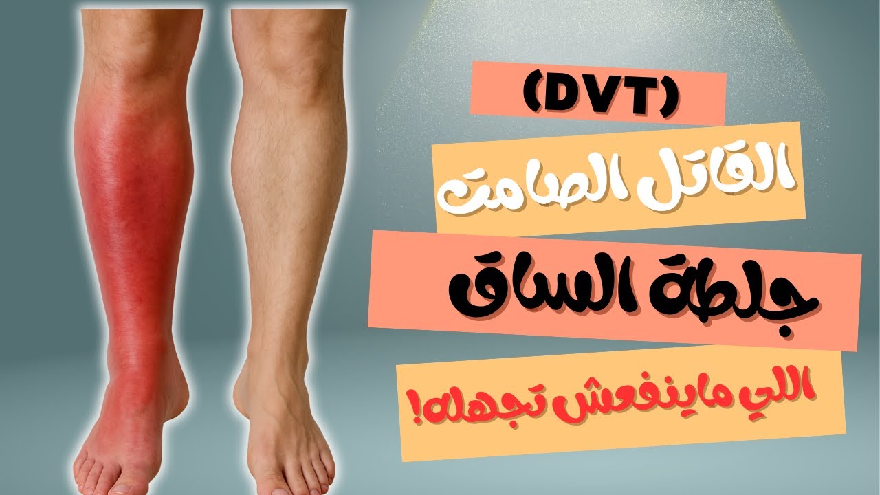 "جلطة الساق (DVT): القاتل الصامت اللي ماينفعش تجهله!"