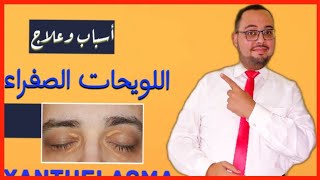 ازالة اللويحات الصفراء بالليزر | ترسب الدهون حول الجفن | Xanthilasma