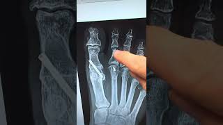 Back to running a half marathon after a first MPJ fusion, Dr. Stewart Timonium Foot and Ankle Center by Timonium Foot and Ankle Center 169 views 2 months ago 3 minutes, 42 seconds