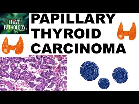 PAPILLARY THYROID CARCINOMA : Gross and Microscopic features