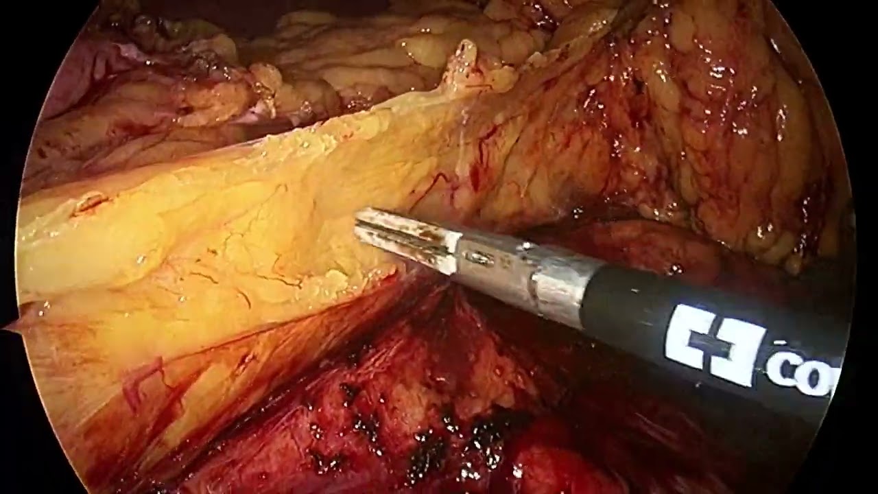 Extended TME - Presacral fascia excision for upper rectal cancer tumour