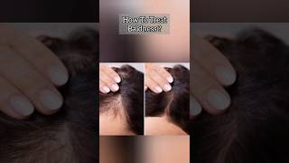 How to Treat Baldness Best product for hair growth haircare hairfall baldness hairgrowth viral