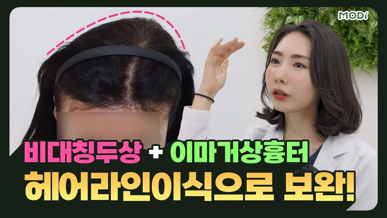 이마거상 후 흉터 + 두상 비대칭, 헤어라인이식으로 보완