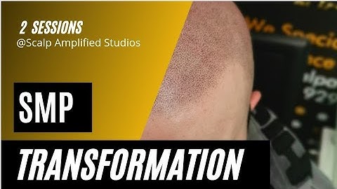Changing your life with SMP (Scalp Micropigmentation), confidence boost even after 2 sessions