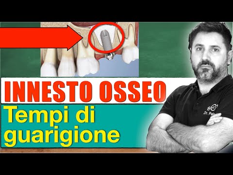 Video: Innesto Osseo: Scopo, Procedura E Rischi