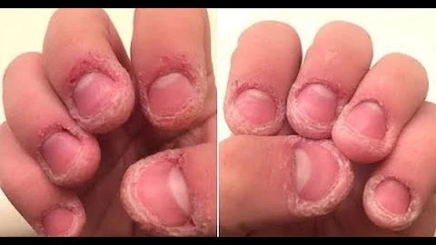 如果你或身边的人有“咬手指”的习惯请立马停止，可怕的后果比你所想的还严重！ - 天天要闻
