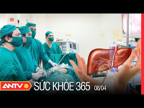 Video: 3 cách điều trị ung thư gan