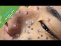 Acne treatment for hung p3  make your day relaxing with windy spa 6201