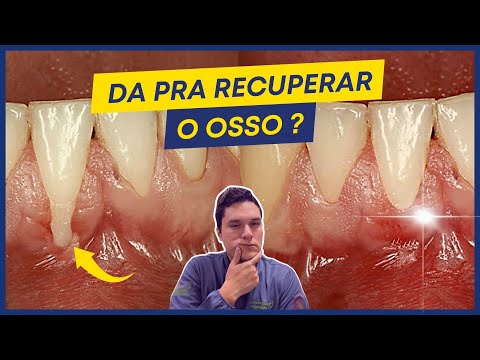 Vídeo: Você pode reconstruir a densidade óssea?