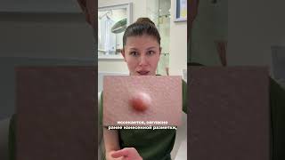 Когда необходимо удаление? #дерматология #хирургия #удаление