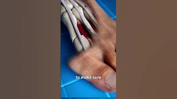 Bunion Correction Explained 