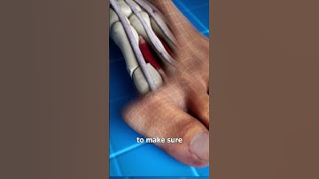 Thumbnail of Bunion Correction 😨 (explained)