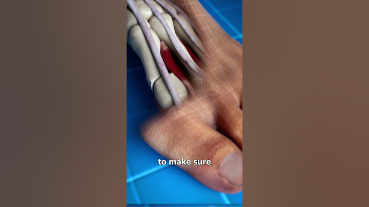Bunion Correction 😨 (explained)
