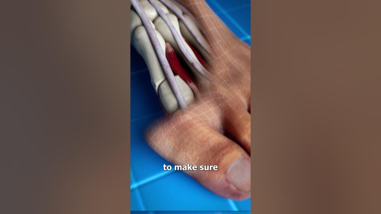 Bunion Correction 😨 (explained)
