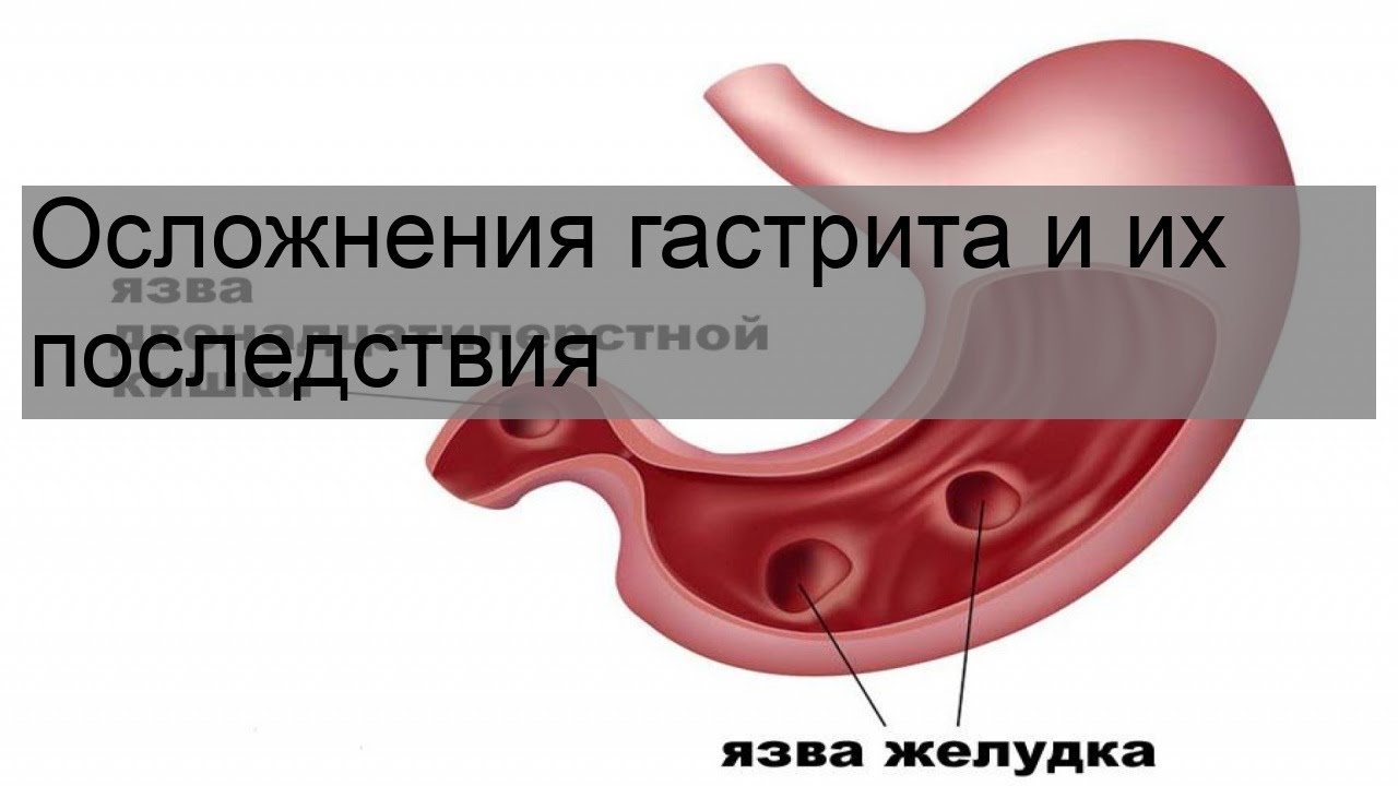 Осложнения гастрита и их последствия