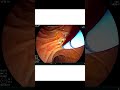 "A rare cause of Upper GI Bleed"