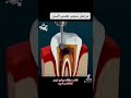 سحب عصب السن ماهي نتائجه شاهد قبل الحذف