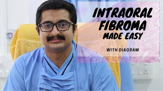 INTRA-ORAL FIBROMA