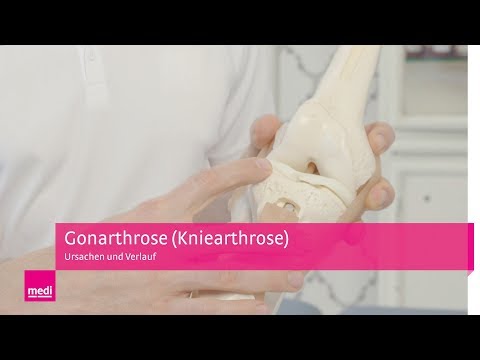 Video: Arthrose Des Kniegelenks: Symptome, Behandlung, Ursachen