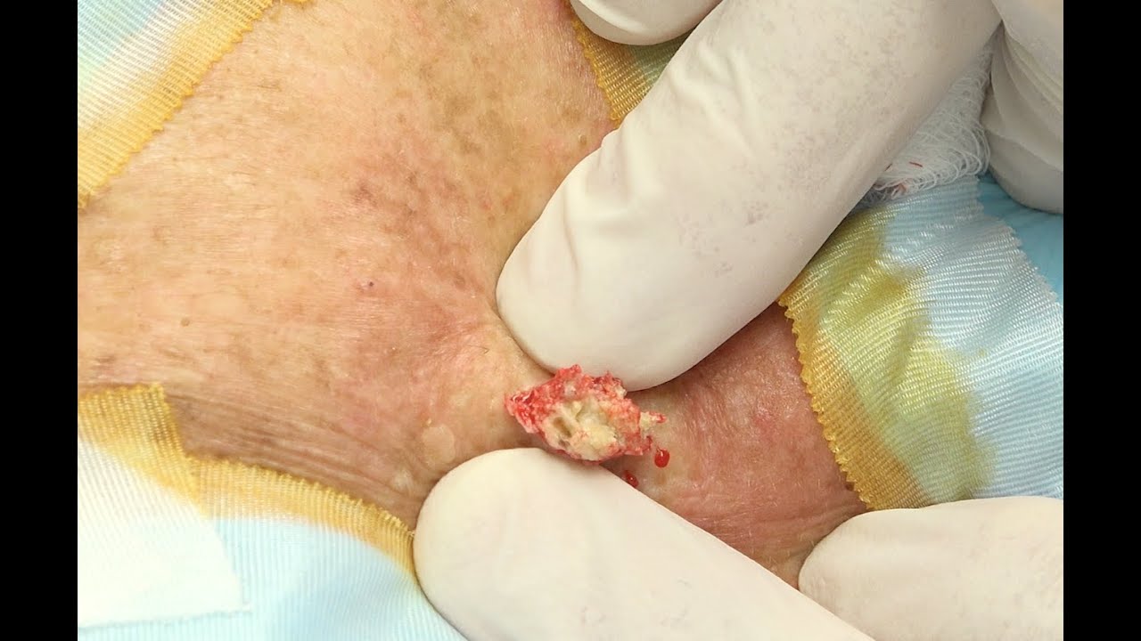 Testicular Cyst Natural Remedies Testicular Cyst Natural Remedies
