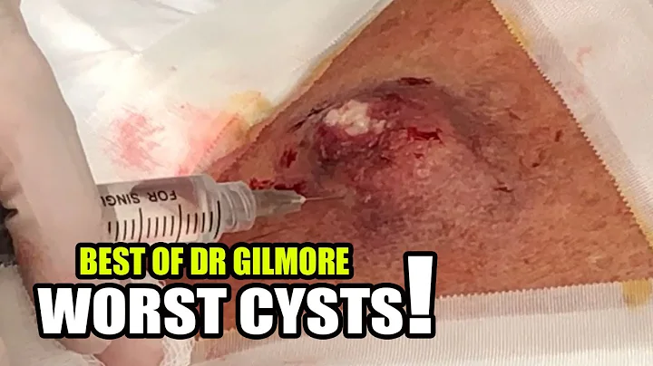 Speedy Back Cyst:  Dr. Gilmore's Worst Extractions
