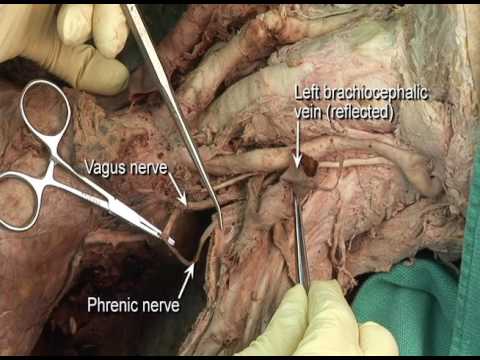 1 3 Step 4 Anterior Scalene Muscle Relation To Subclavian Vein And Phrenic