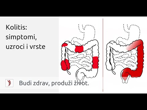 Video: Kolageni Kolitis: Simptomi, Vzroki, Zdravljenje In še Več