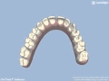 CORREZIONE DIASTEMA (OCCLUSALE)