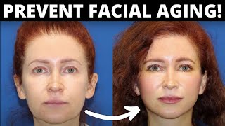 A Facelift in your 40s? How to Delay Facial Aging with a Preventative Face Lift!