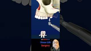 Need an Implant? You Might Need a Sinus Lift First #dentalartistry #dentist #wellnessforlife