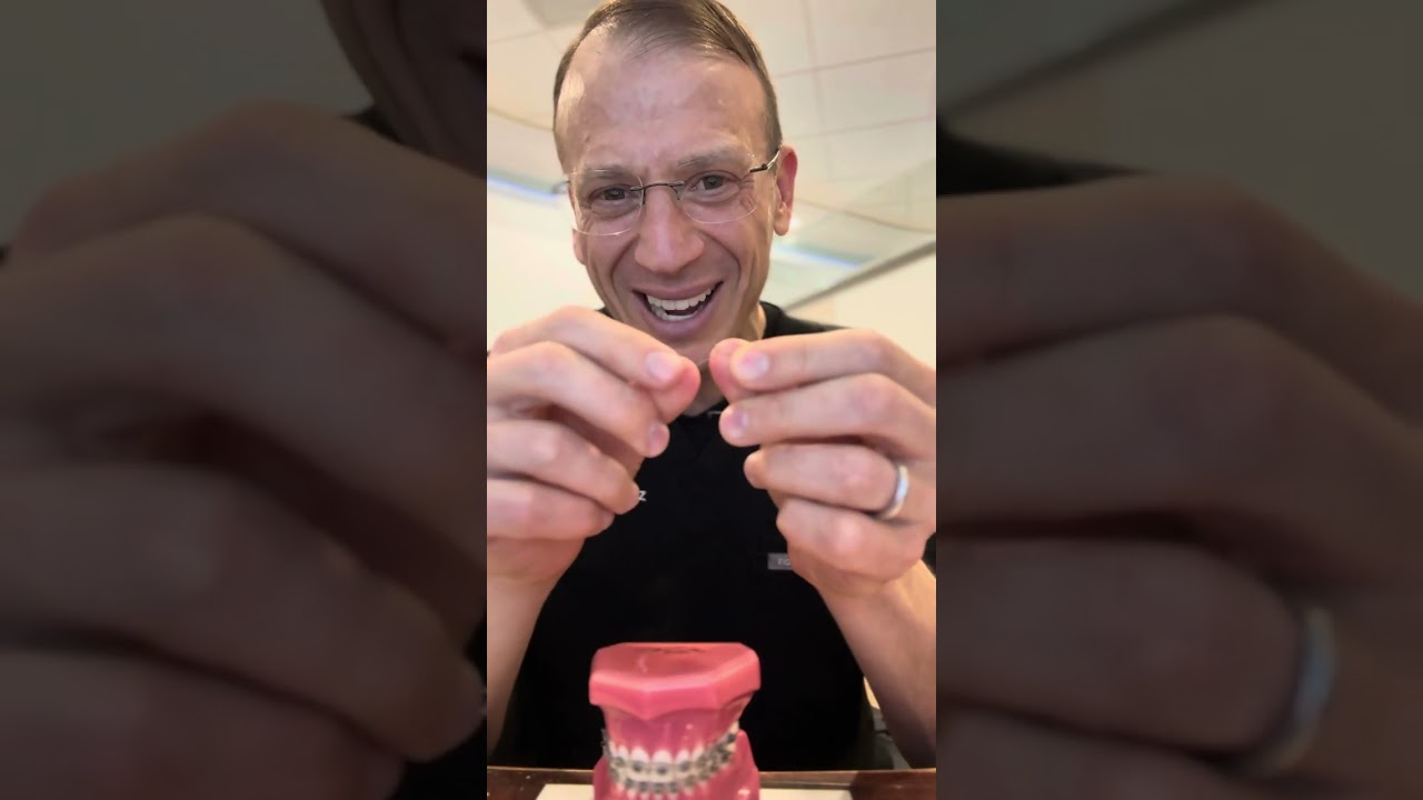 The ART (Anterior Root Torquing) Spring