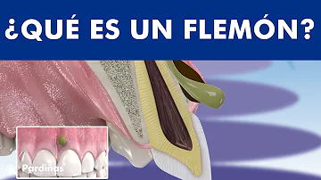 ¿Es frecuente que un absceso dental se extienda?