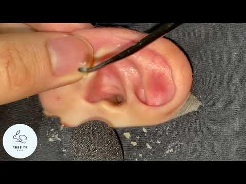 ASMR Ear Cleaning Earwax Extraction [No Talking 🚫] (耳掃除 / 귀청소)