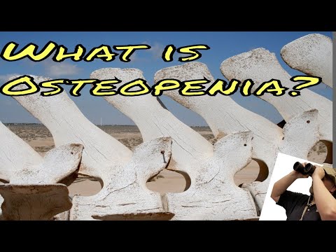 What is Osteopenia?  A brief description of what osteopenia and osteoporosis are.