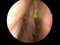 Endo Repair of Nasal CSF Leak (Brain Fluid Runny Nose)