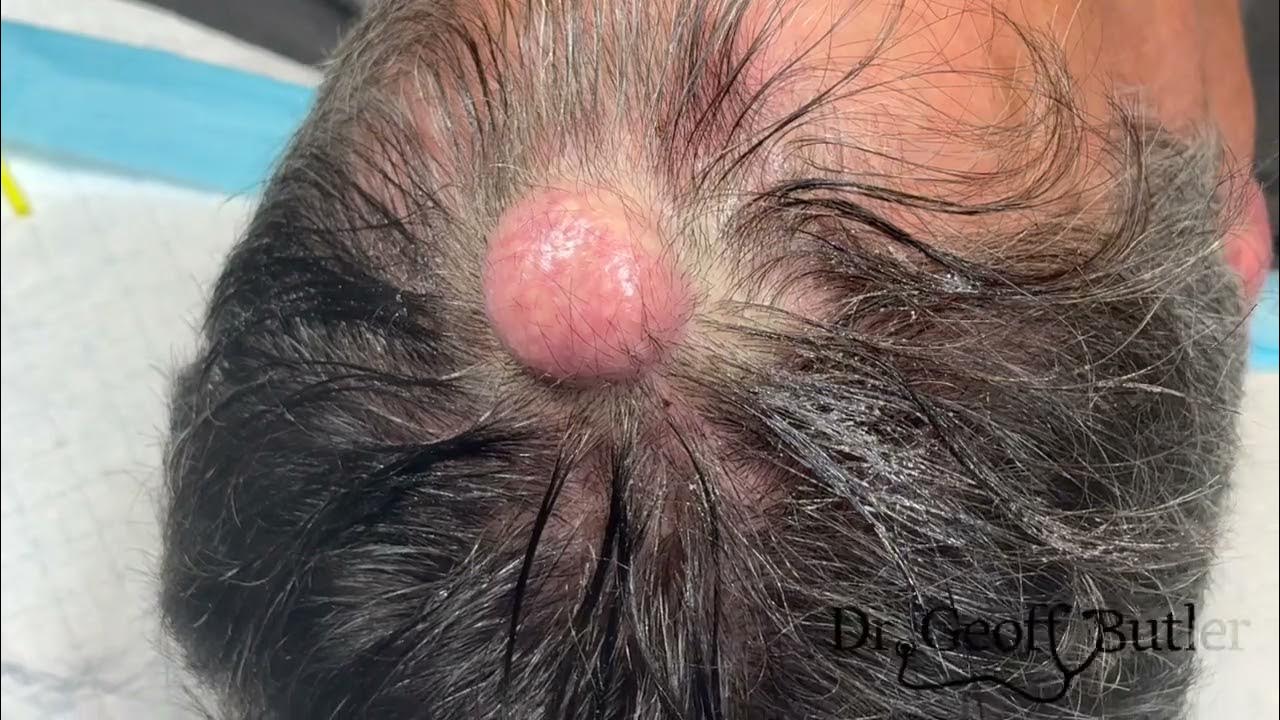removal-of-a-decent-sized-pilar-cyst-on-the-scalp-youtube