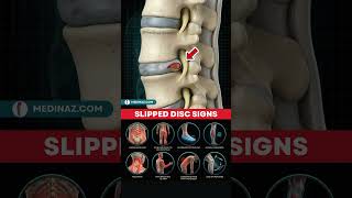 Download Lagu Slipped Disc Symptoms You Should NEVER Ignore | Slipped Disc Signs MP3