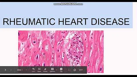 Rheumatic Heart Disease: Pathogenesis, Morphology, Clinical features