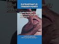 How to Release Supraspinatus Trigger Points