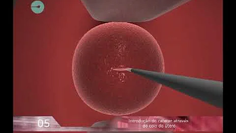 Quanto tempo dura a transferência de embrião?